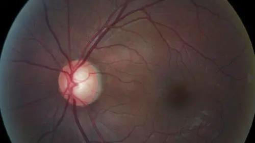 青光眼的克星来袭，助力患者远离视力的“窃贼”